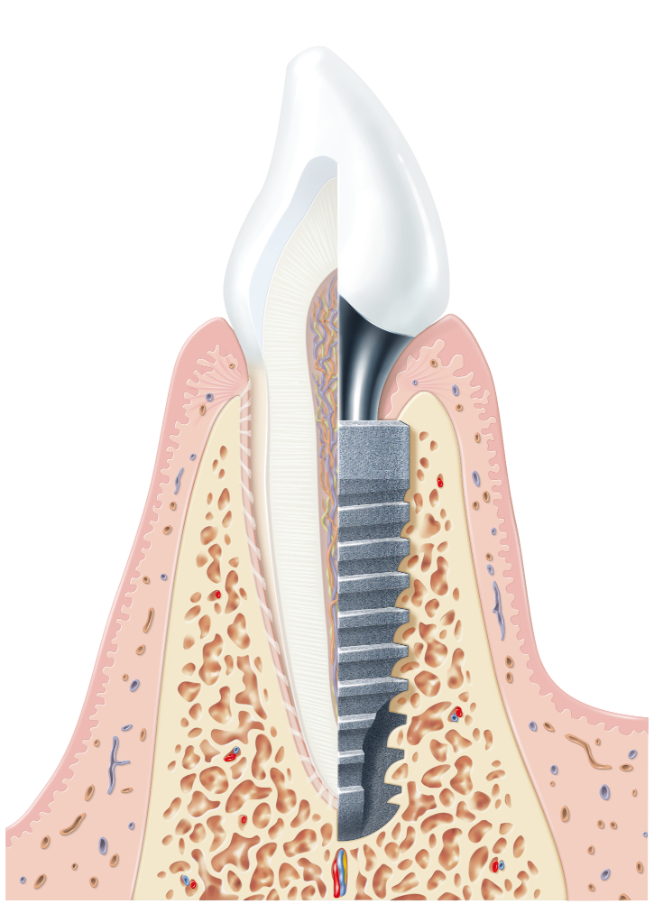 Dental implant model